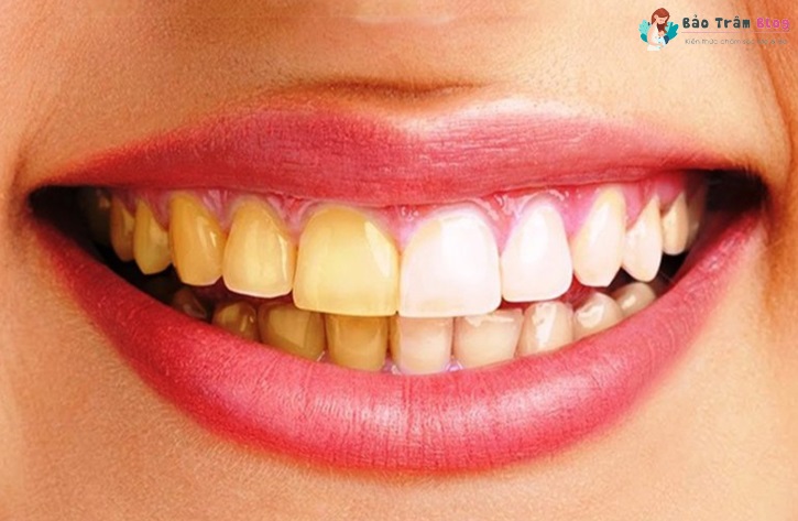 Răng bị ố vàng phải làm sao?